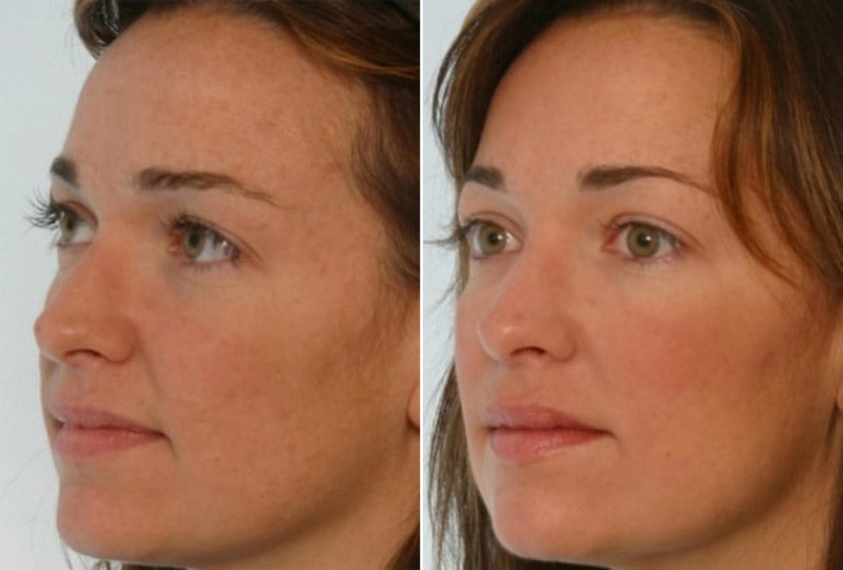 Radiesse Before & After Gallery - Patient 55453060 - Image 1