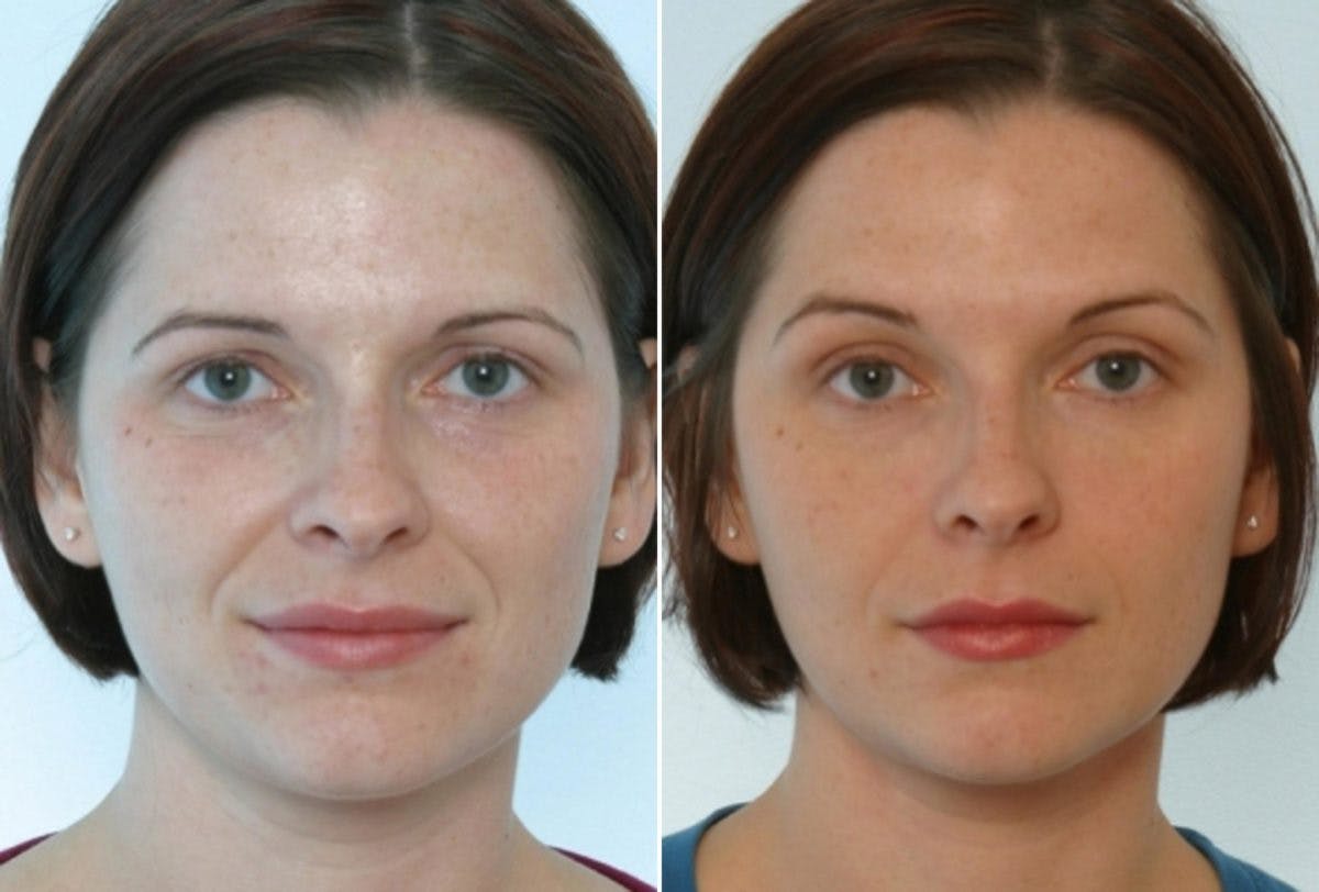 Radiesse Before & After Photo - Patient 55453061 - Image 1