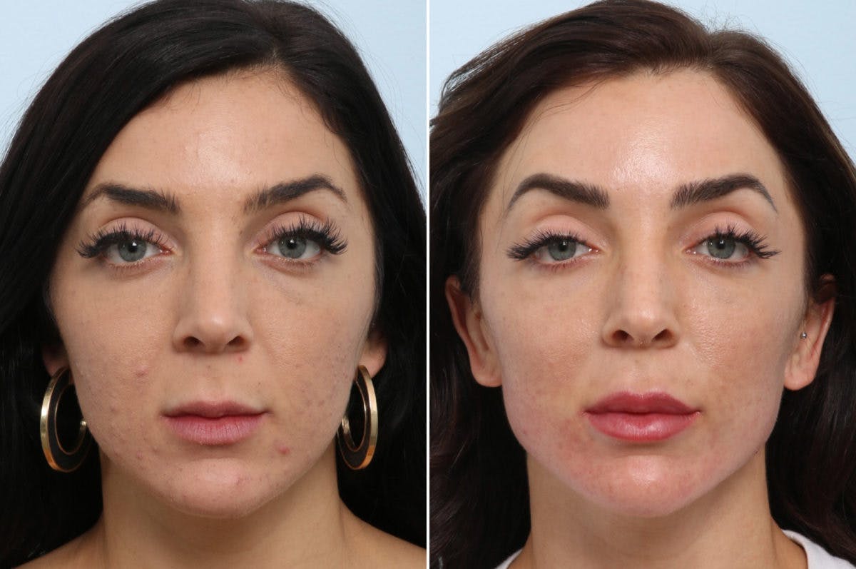 Radiesse Before & After Gallery - Patient 55171236 - Image 1