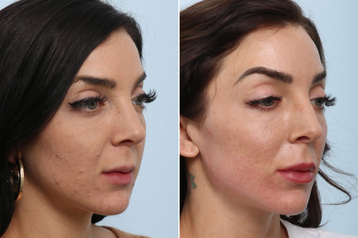 Radiesse Before & After Gallery - Patient 55171236 - Image 2