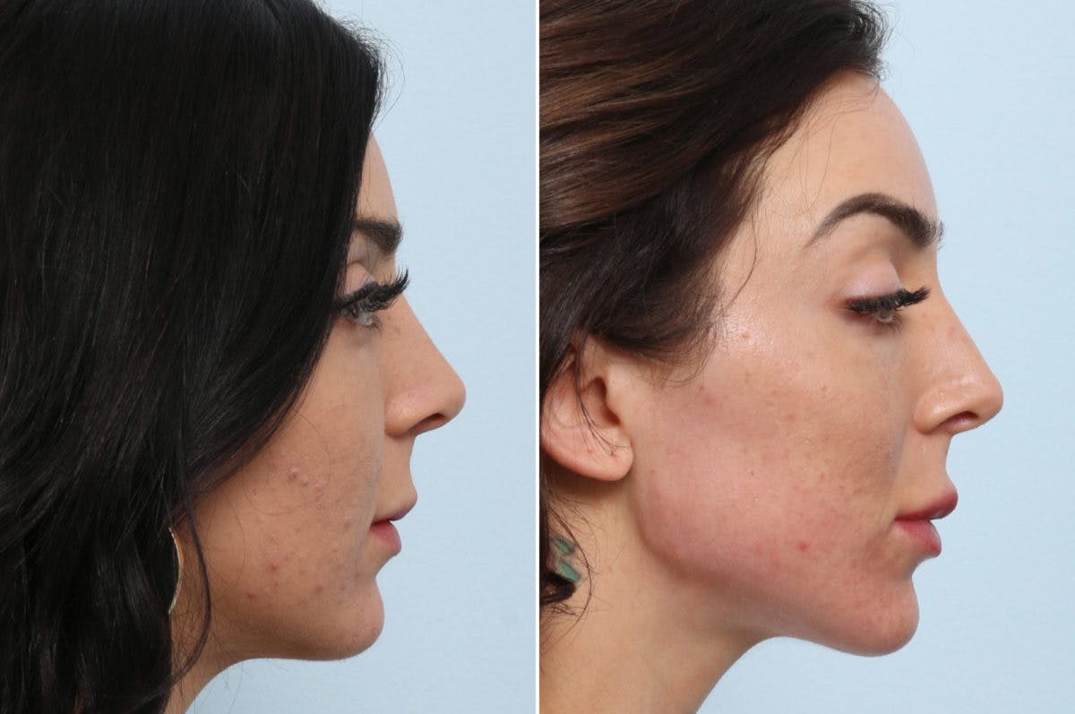 Radiesse Before & After Photo - Patient 55171236 - Image 3