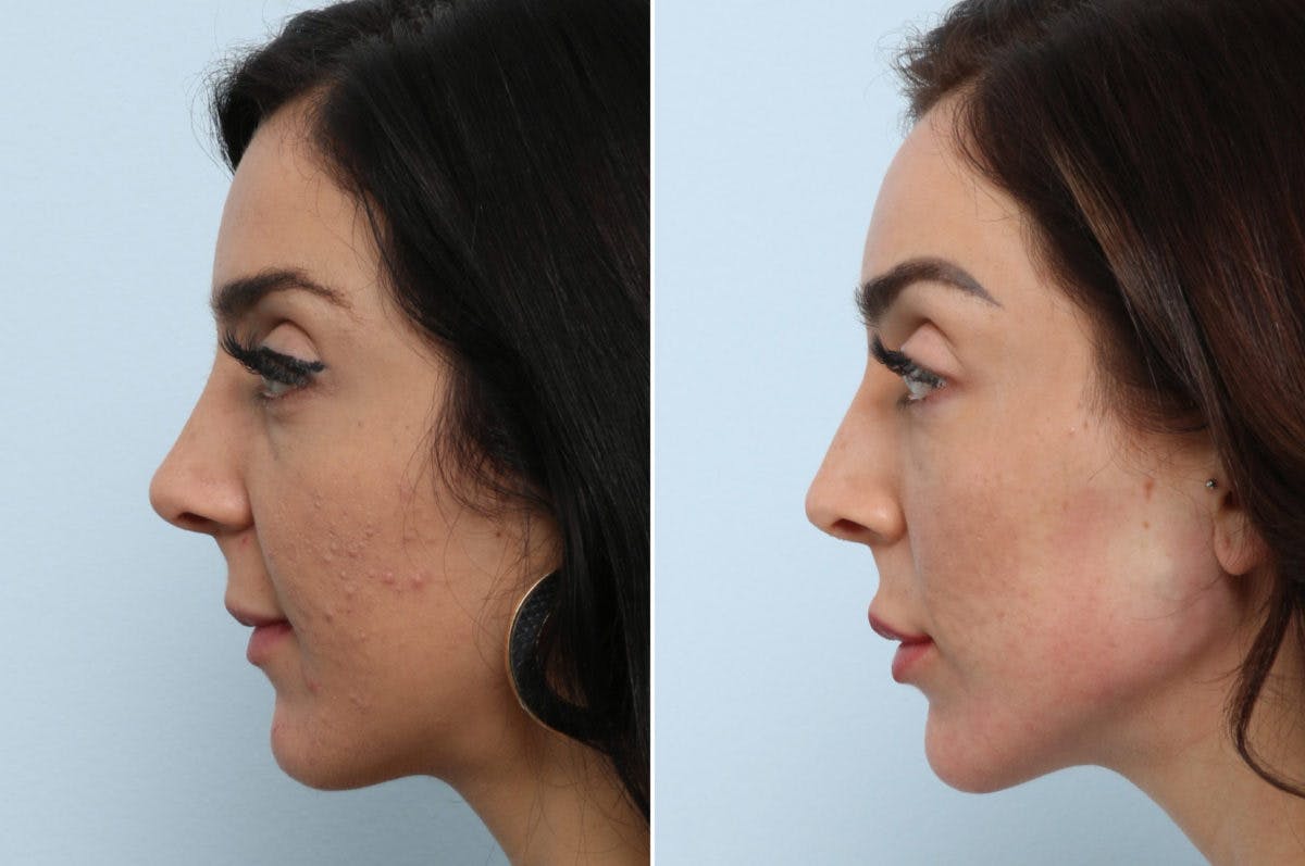 Radiesse Before & After Photo - Patient 55171236 - Image 5