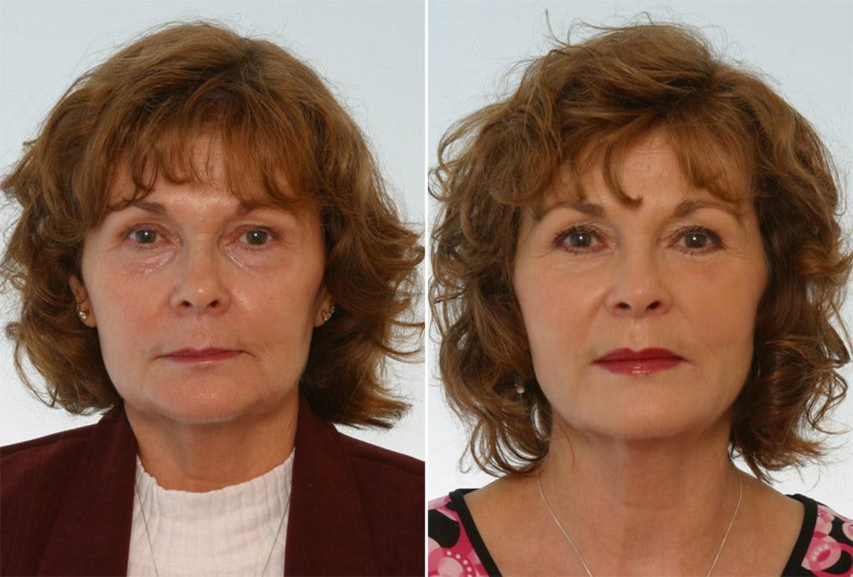 Radiesse Before & After Gallery - Patient 55171238 - Image 1