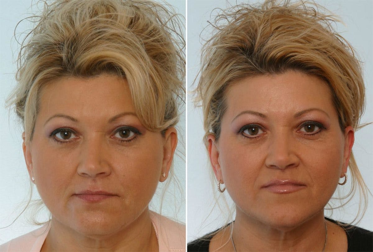 Restylane Before & After Gallery - Patient 55171260 - Image 1