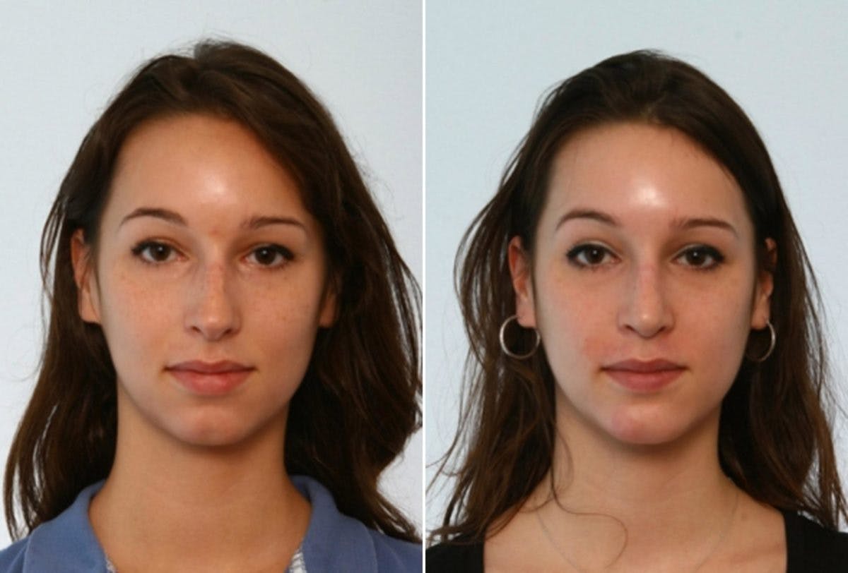 Rhinoplasty Before & After Photo - Patient 55171265 - Image 1