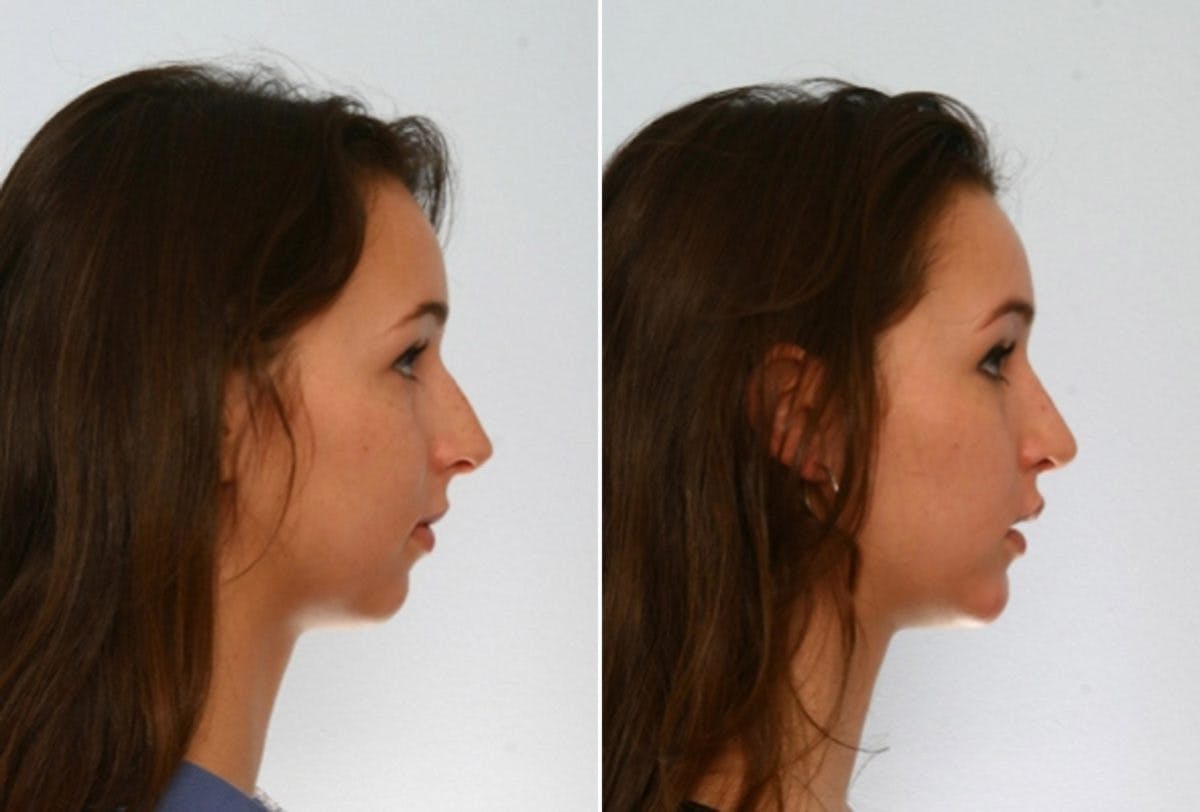 Rhinoplasty Before & After Gallery - Patient 55171265 - Image 2