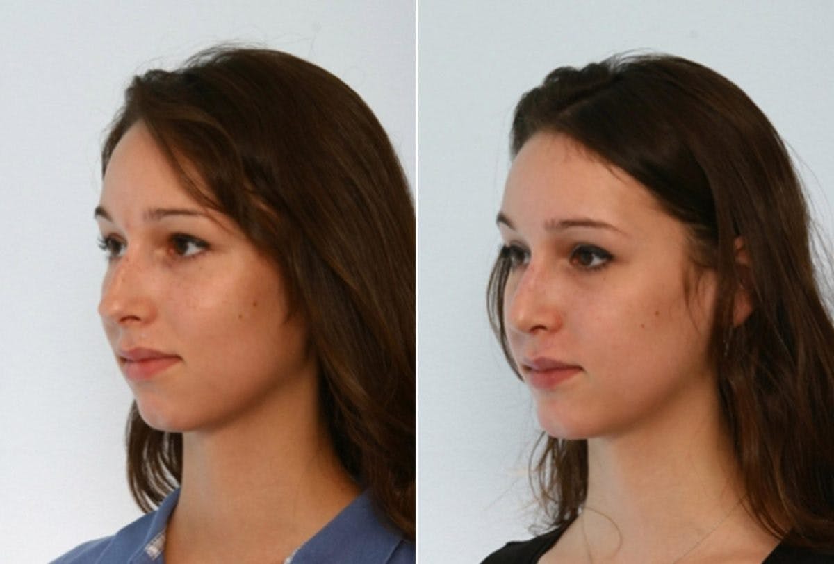 Rhinoplasty Before & After Gallery - Patient 55171265 - Image 4