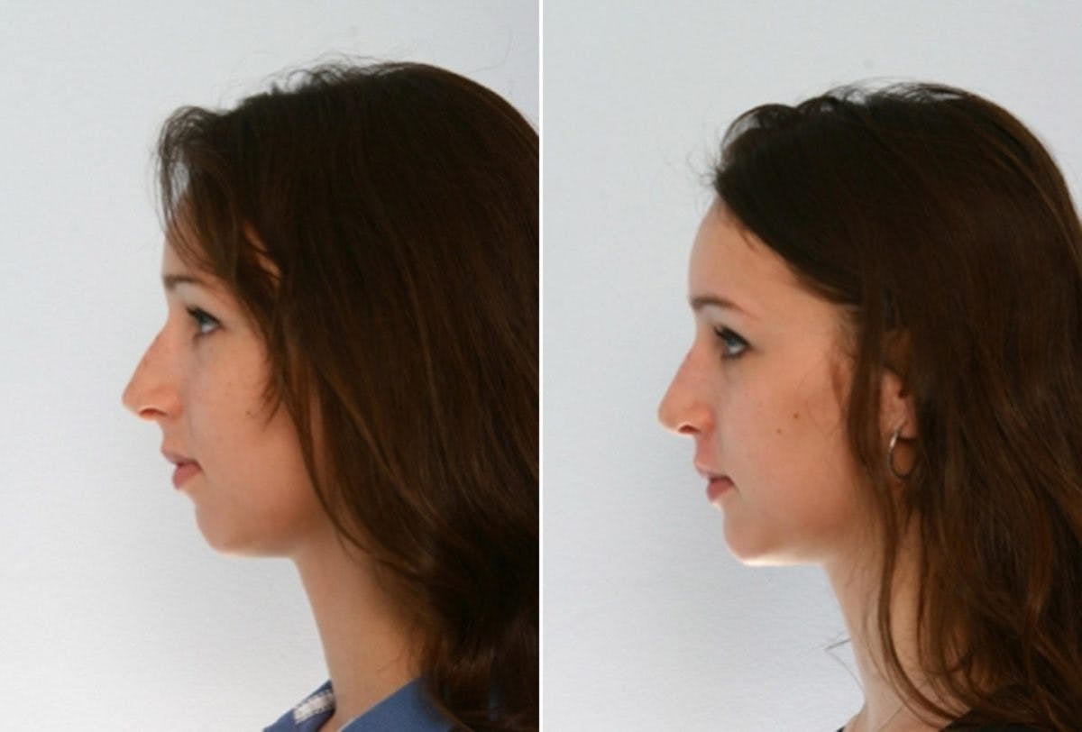 Rhinoplasty Before & After Gallery - Patient 55171265 - Image 5