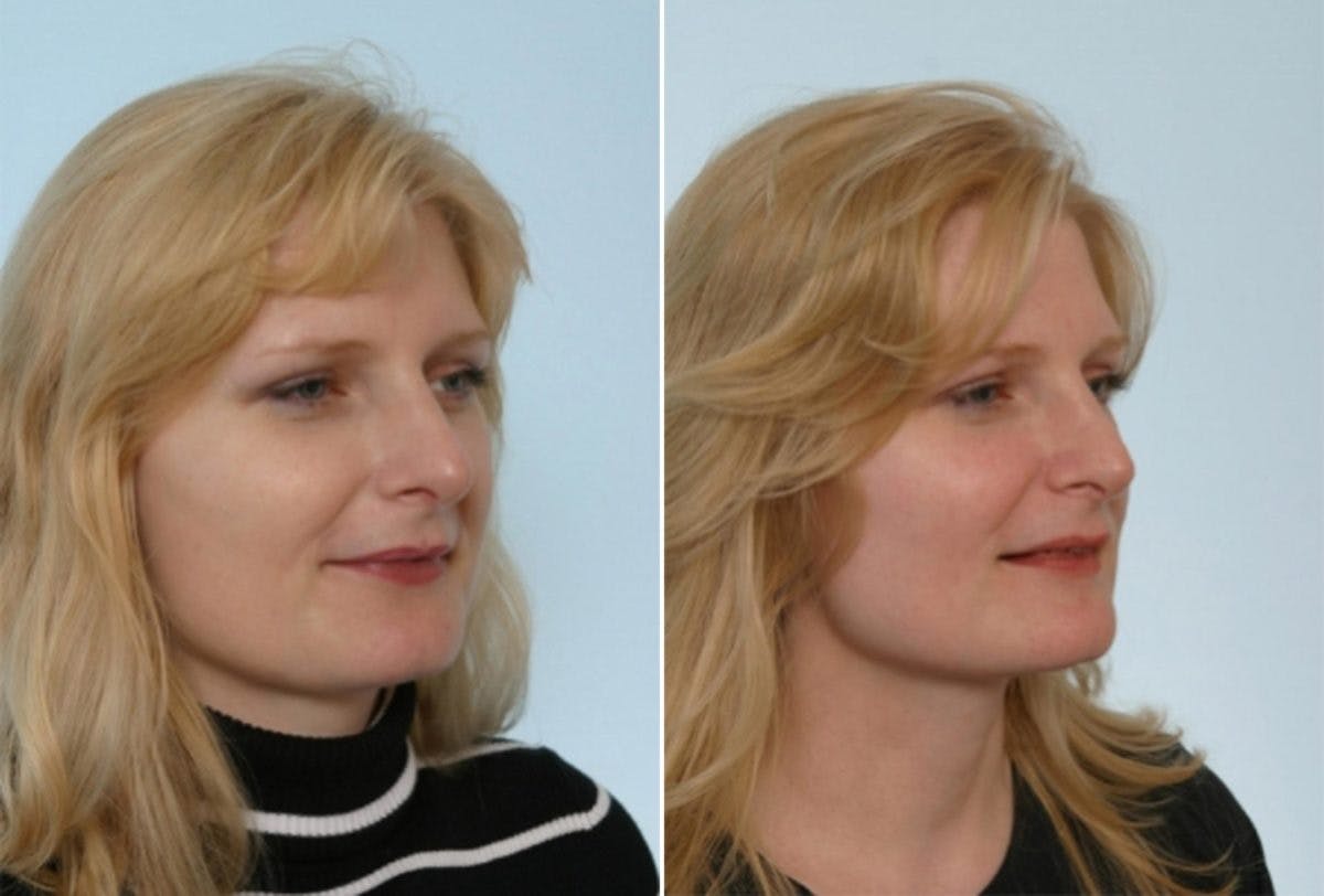 Rhinoplasty Before & After Gallery - Patient 55171266 - Image 3