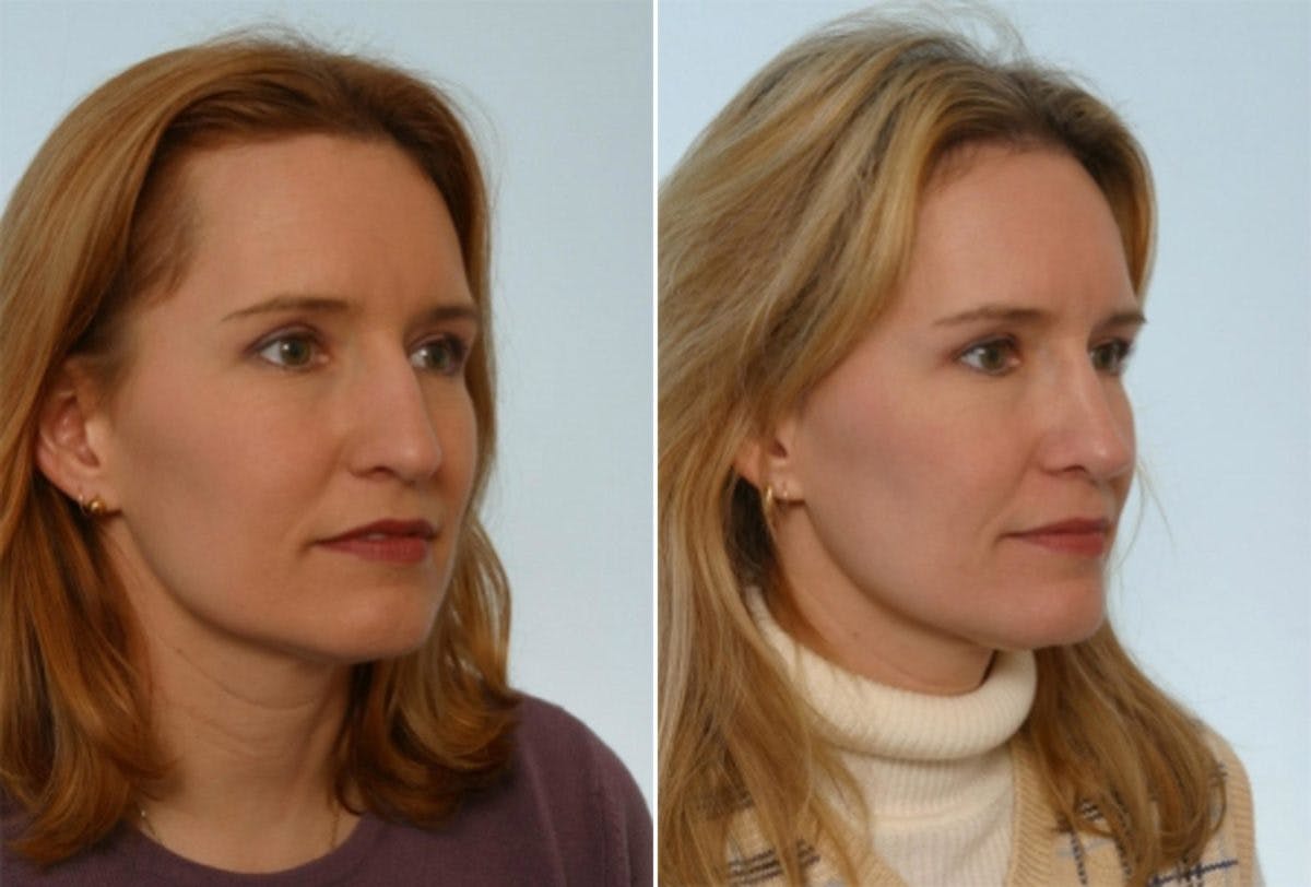 Rhinoplasty Before & After Gallery - Patient 55171267 - Image 3