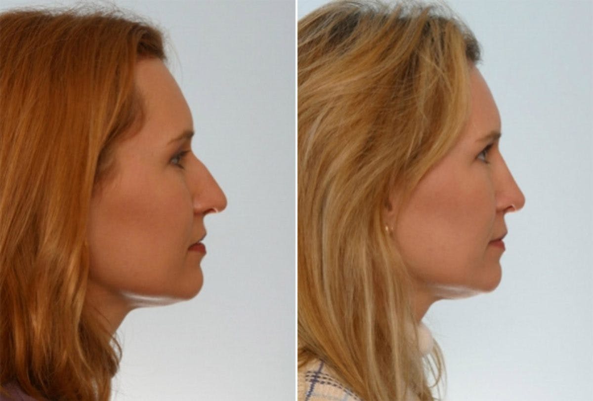 Rhinoplasty Before & After Gallery - Patient 55171267 - Image 2