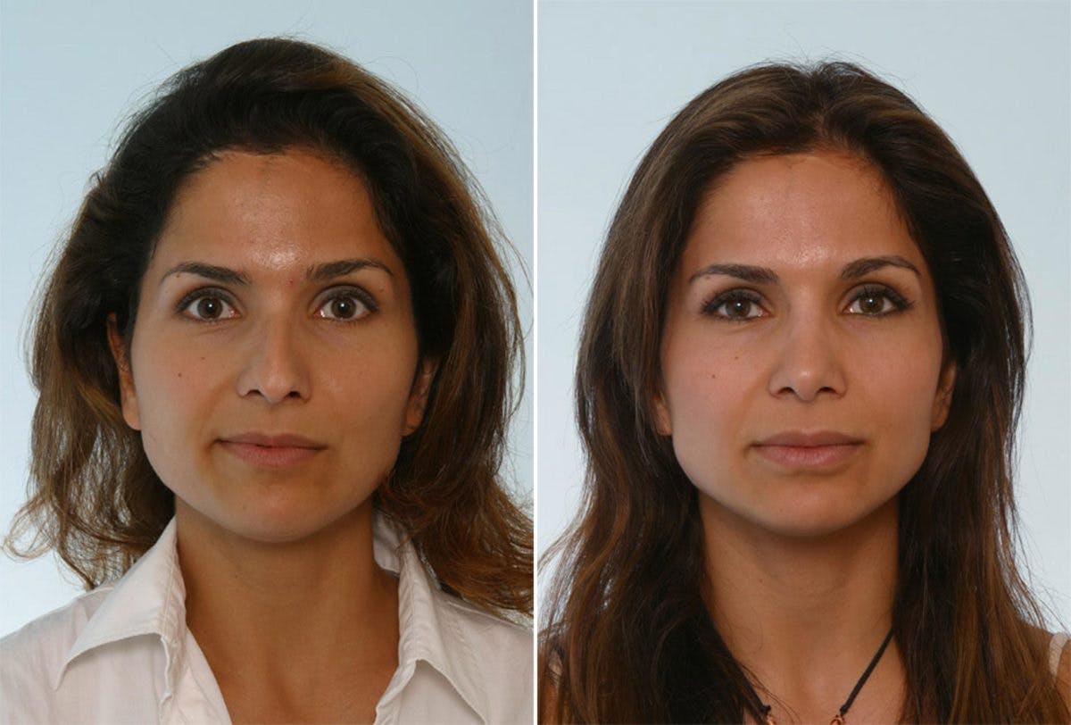 Rhinoplasty Before & After Photo - Patient 55171268 - Image 1