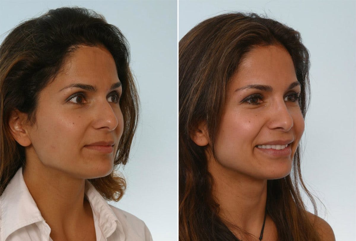 Rhinoplasty Before & After Photo - Patient 55171268 - Image 3