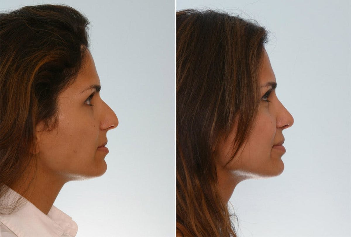 Rhinoplasty Before & After Gallery - Patient 55171268 - Image 2