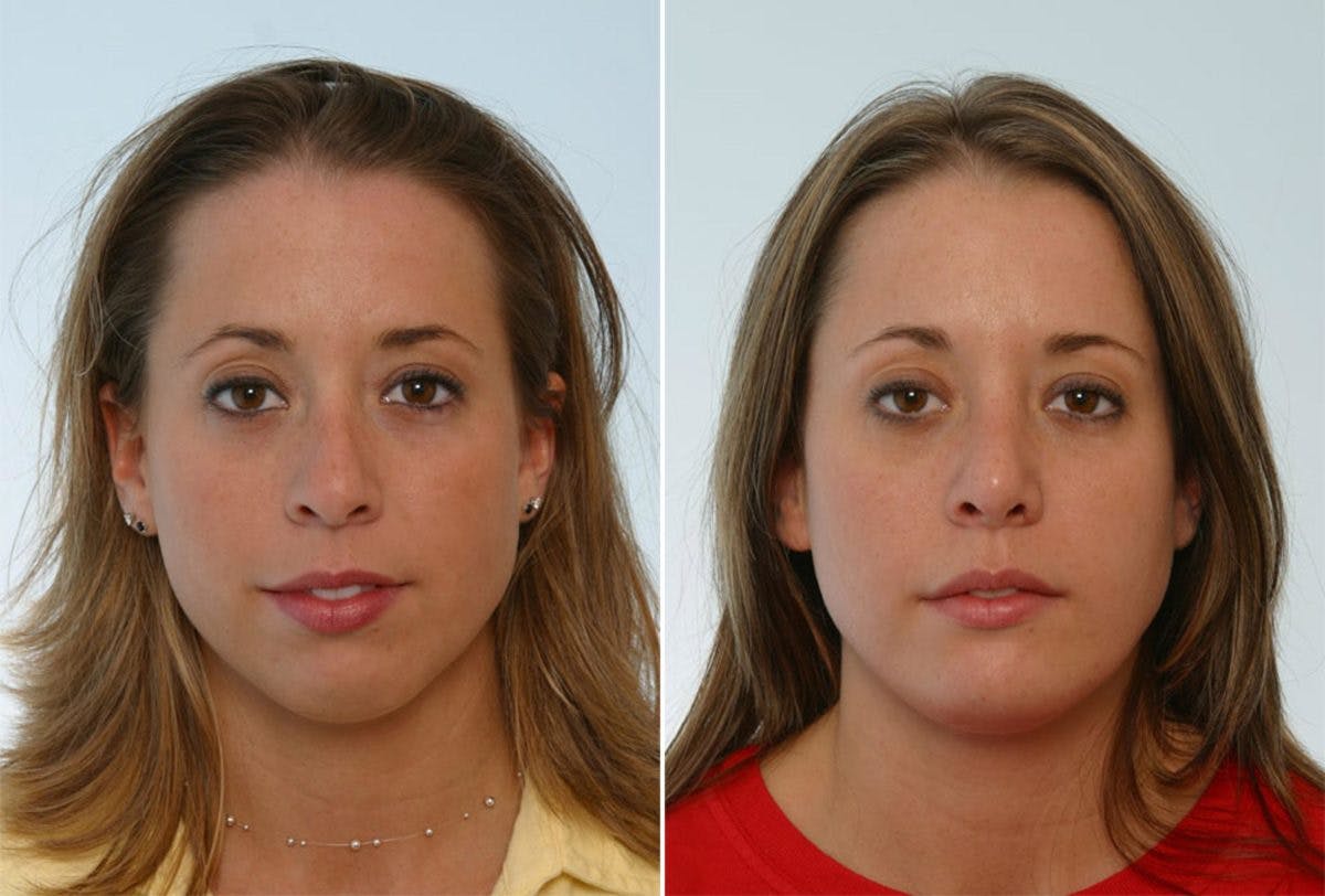 Rhinoplasty Before & After Gallery - Patient 55171269 - Image 1