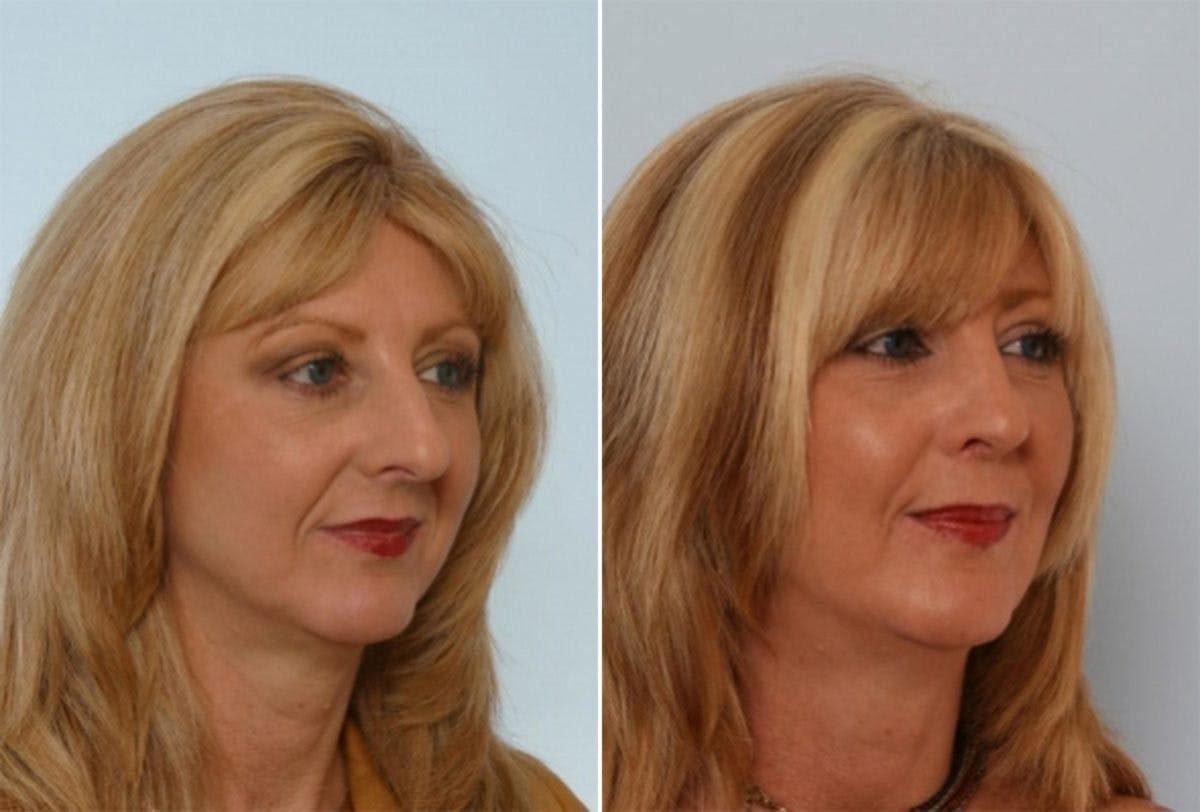 Rhinoplasty Before & After Gallery - Patient 55171271 - Image 3
