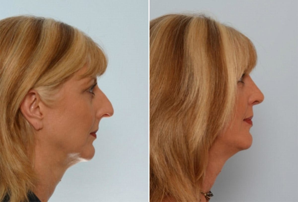 Rhinoplasty Before & After Gallery - Patient 55171271 - Image 2