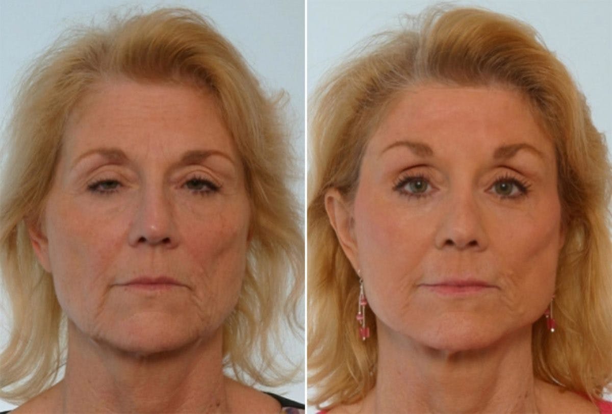 Rhinoplasty Before & After Gallery - Patient 55171272 - Image 1