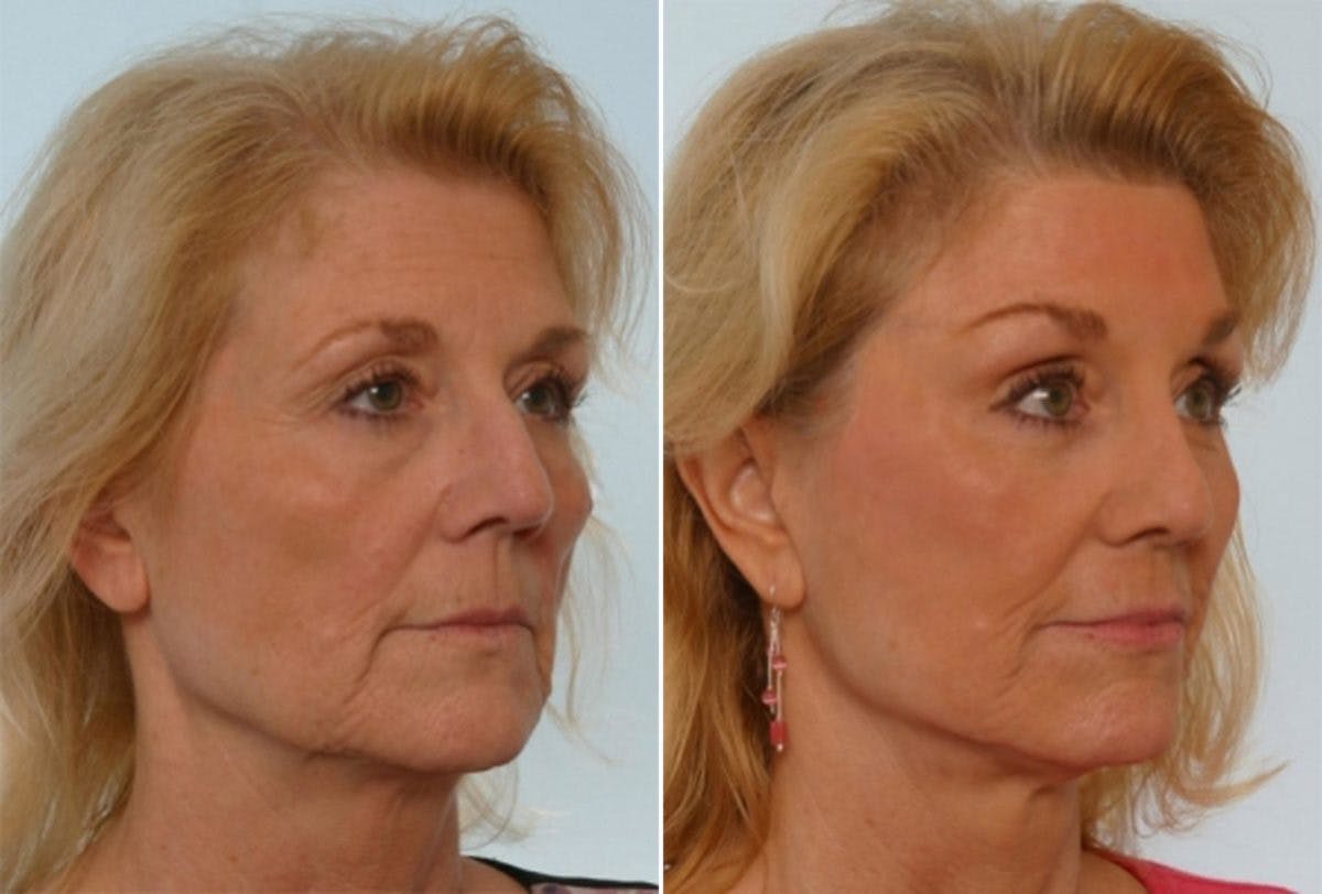 Rhinoplasty Before & After Gallery - Patient 55171272 - Image 3