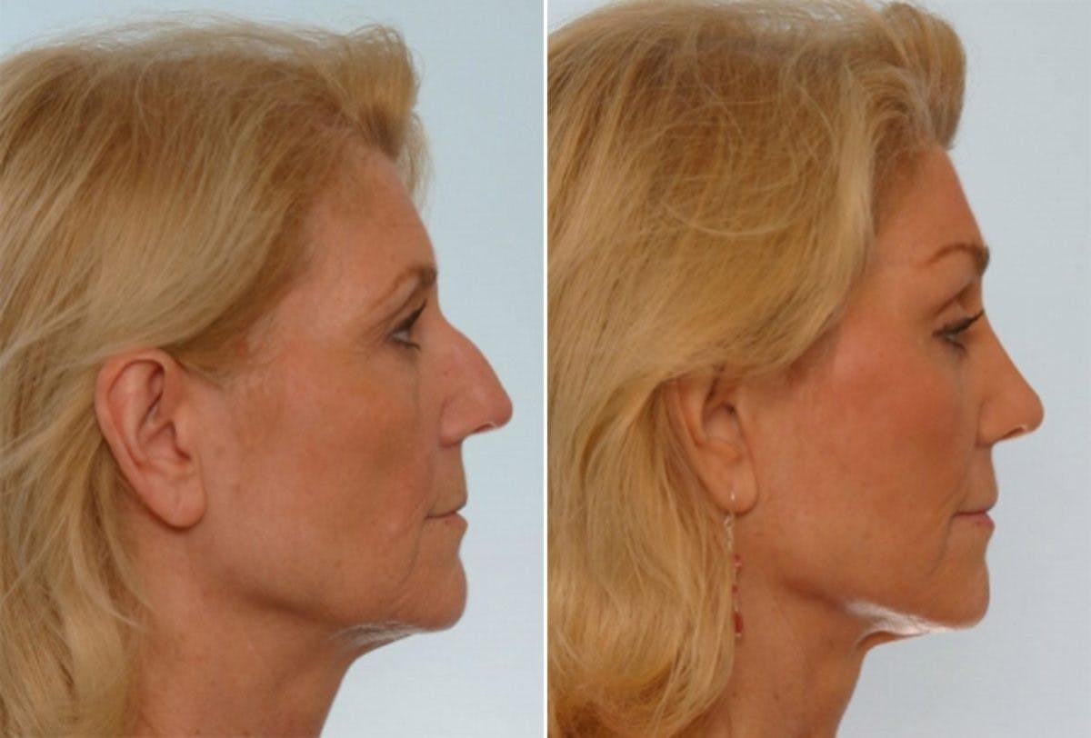 Rhinoplasty Before & After Gallery - Patient 55171272 - Image 2