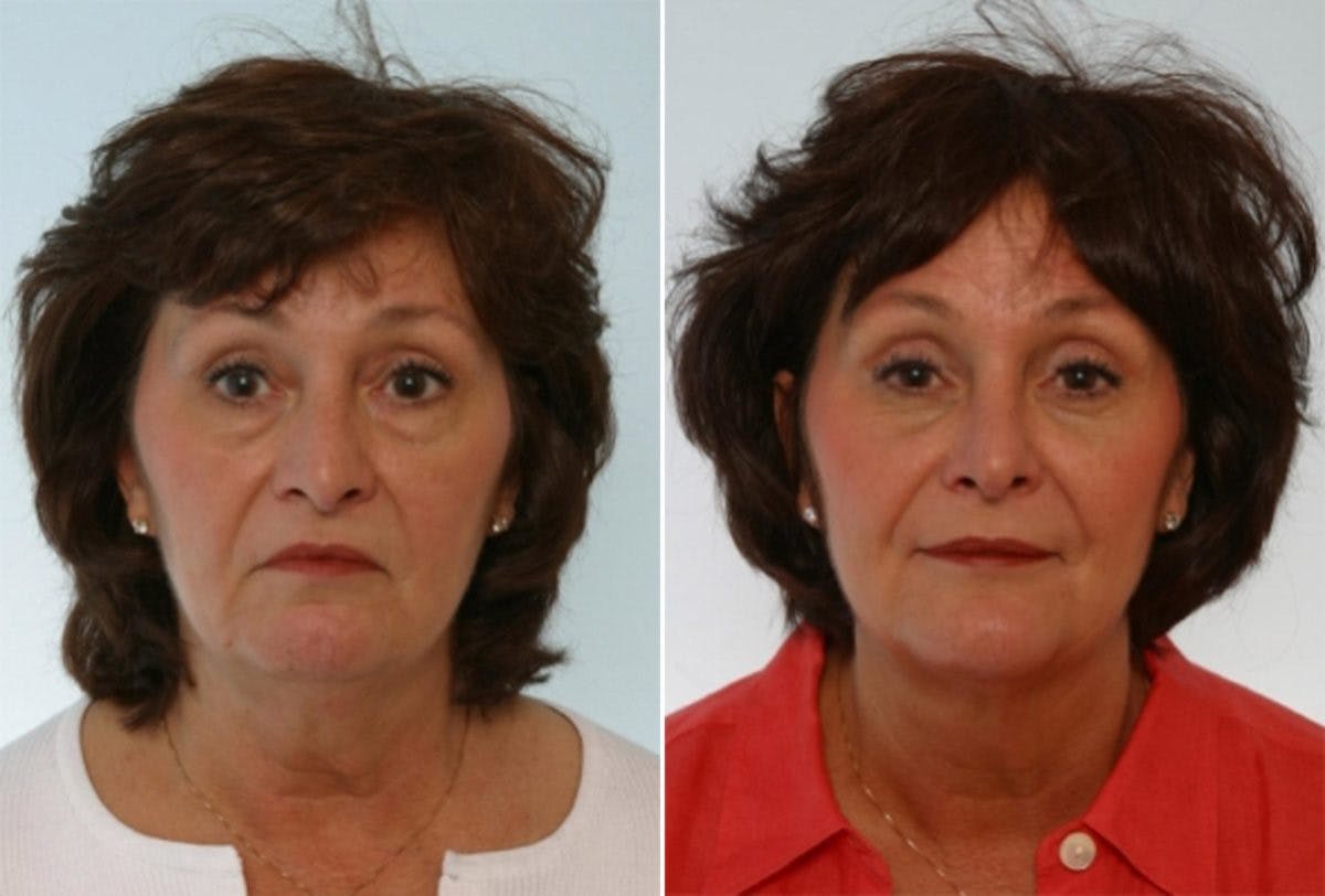 Rhinoplasty Before & After Gallery - Patient 55171273 - Image 1