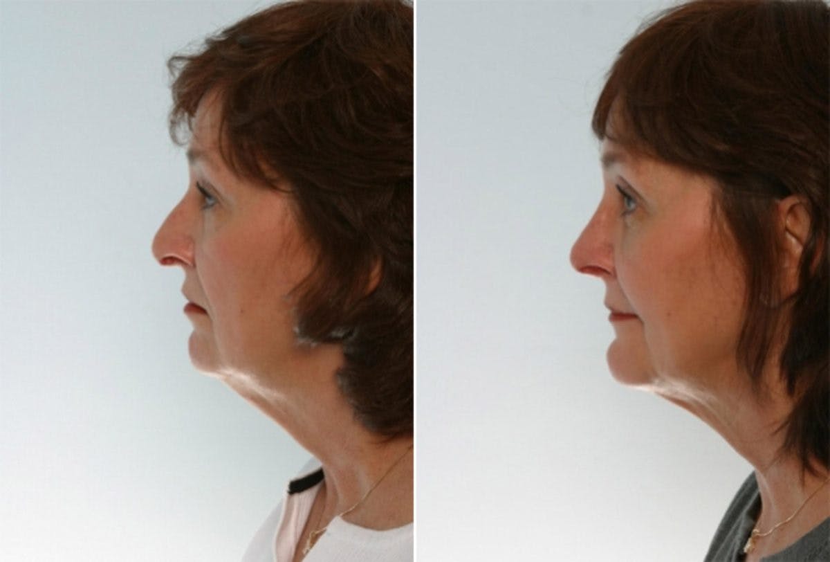 Rhinoplasty Before & After Gallery - Patient 55171273 - Image 2