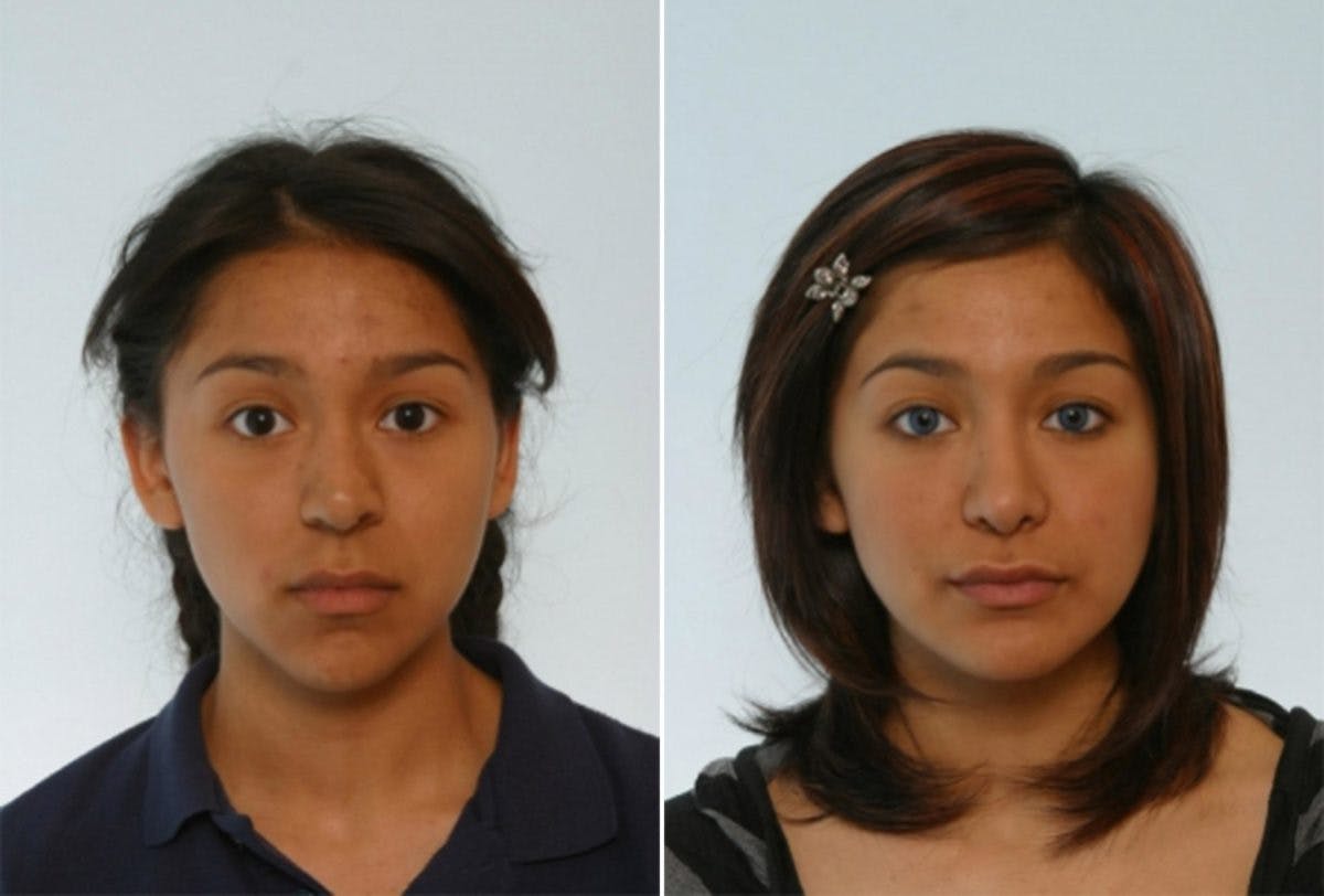 Rhinoplasty Before & After Gallery - Patient 55171274 - Image 1