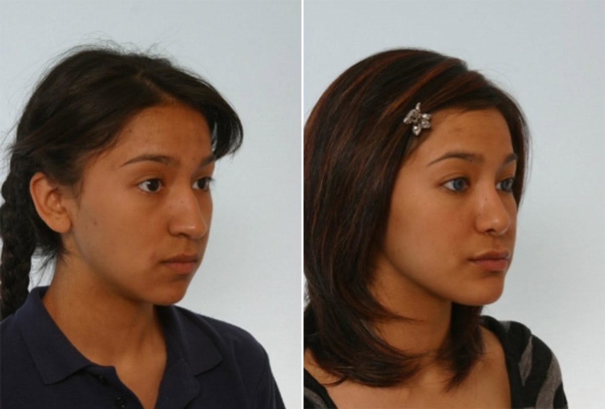 Rhinoplasty Before & After Gallery - Patient 55171274 - Image 3