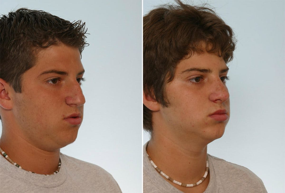 Rhinoplasty Before & After Gallery - Patient 55171275 - Image 3