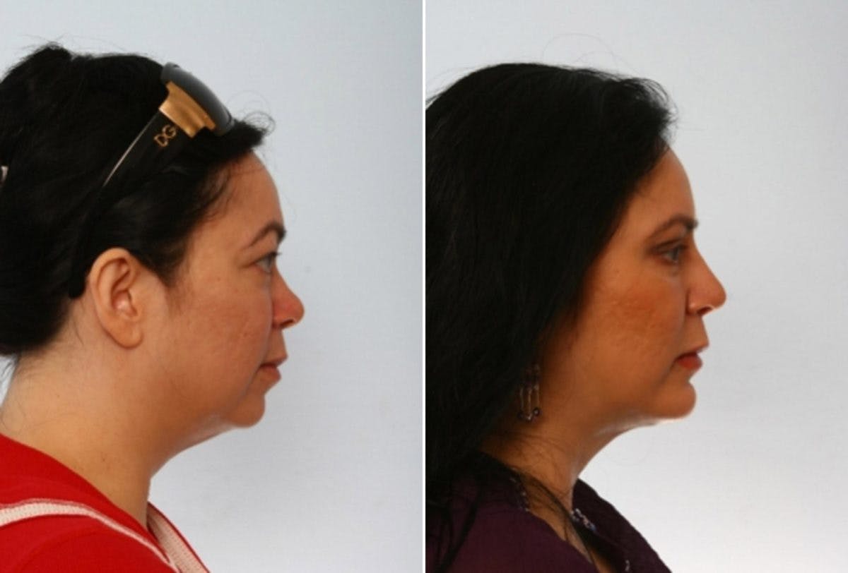 Rhinoplasty Before & After Gallery - Patient 55171277 - Image 2