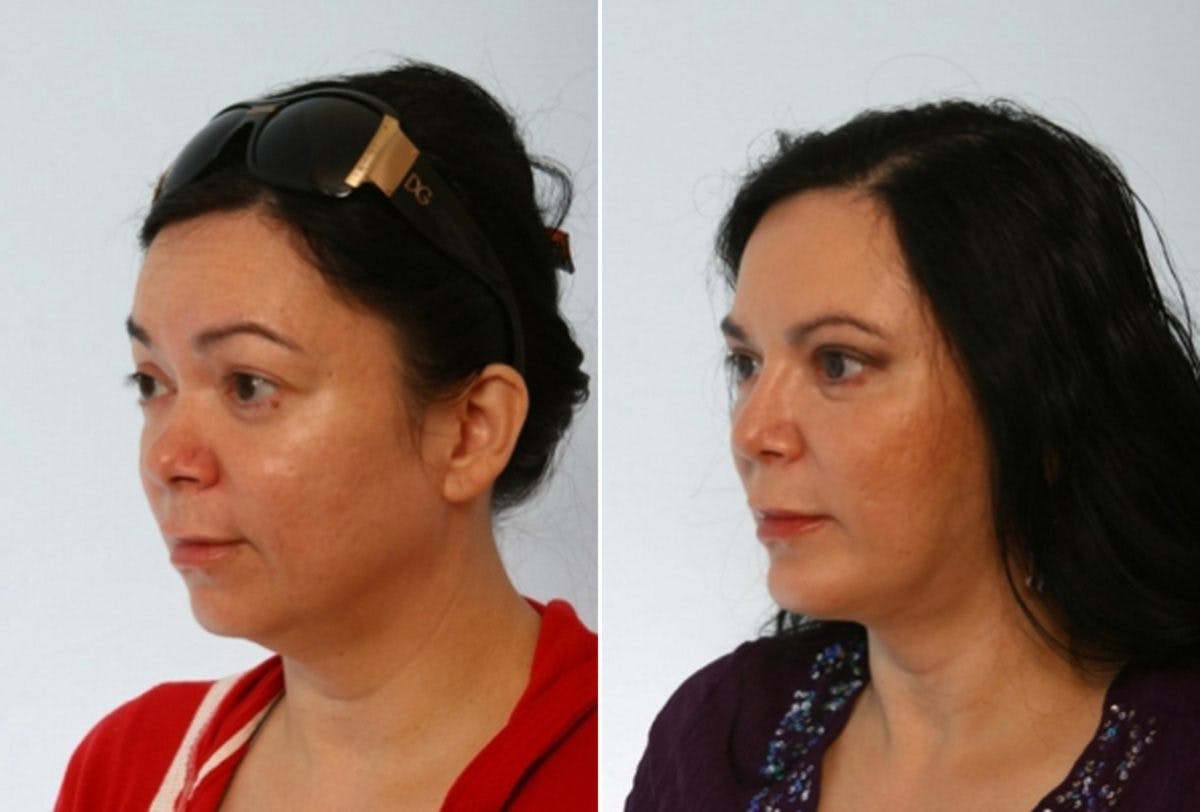 Rhinoplasty Before & After Gallery - Patient 55171277 - Image 4