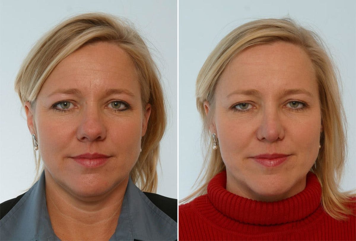 Rhinoplasty Before & After Photo - Patient 55171278 - Image 1