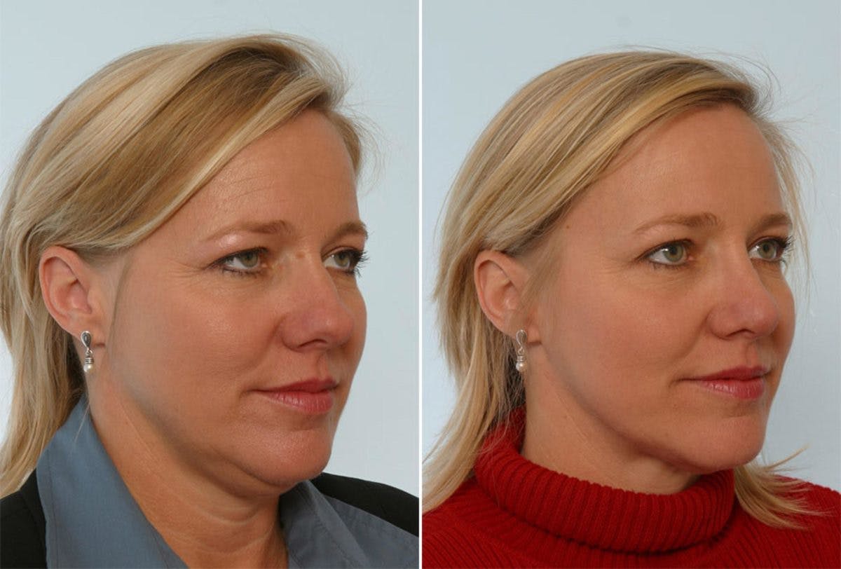 Rhinoplasty Before & After Gallery - Patient 55171278 - Image 3