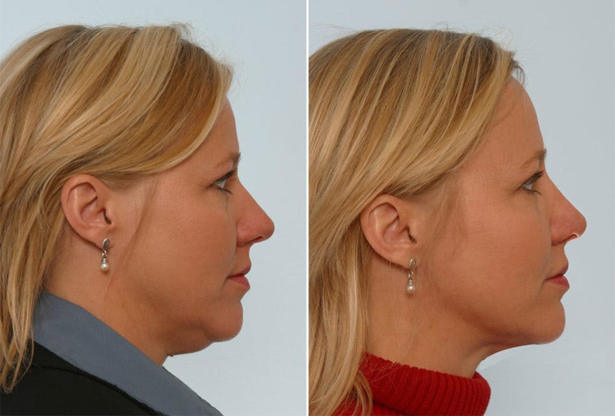 Rhinoplasty Before & After Photo - Patient 55171278 - Image 2