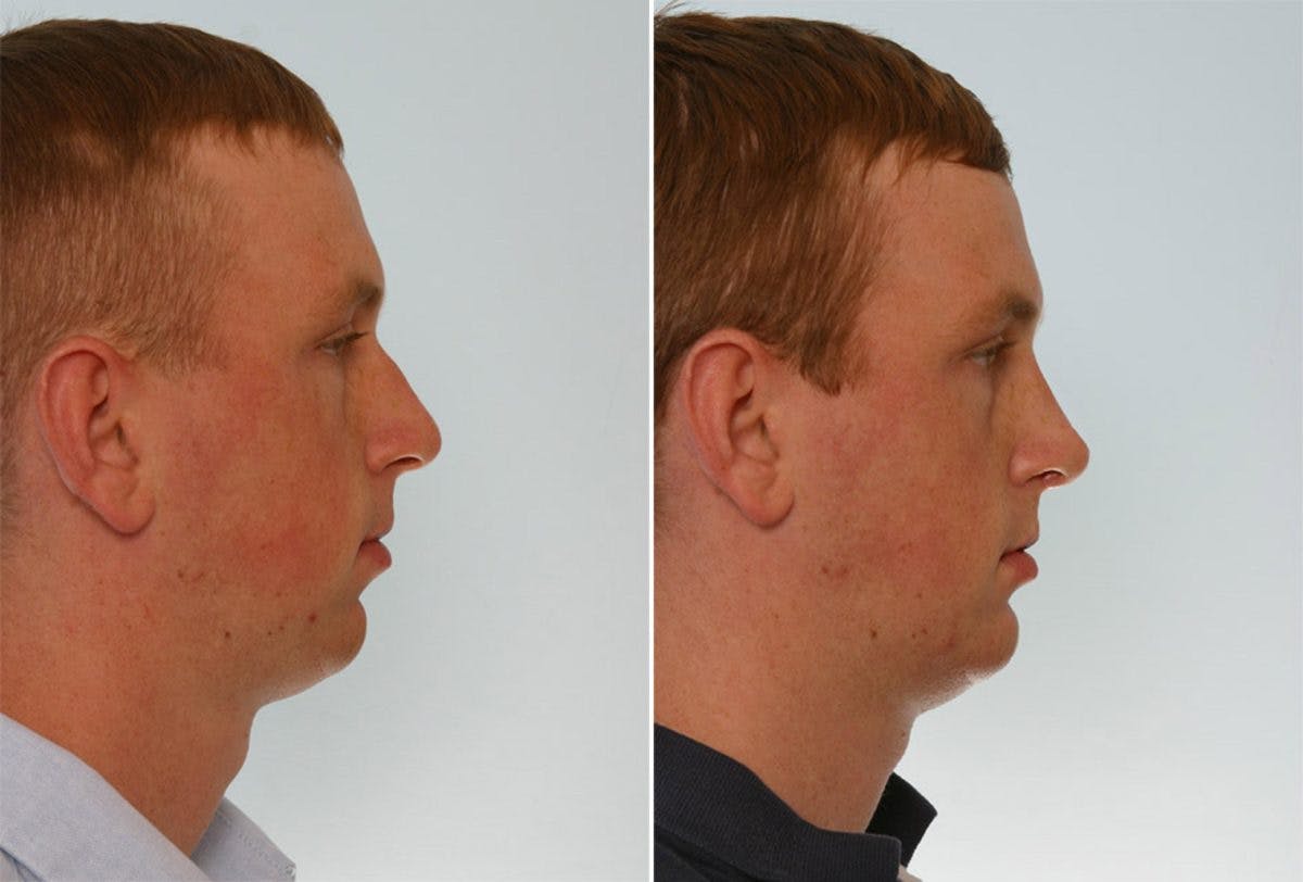 Rhinoplasty Before & After Gallery - Patient 55171279 - Image 2