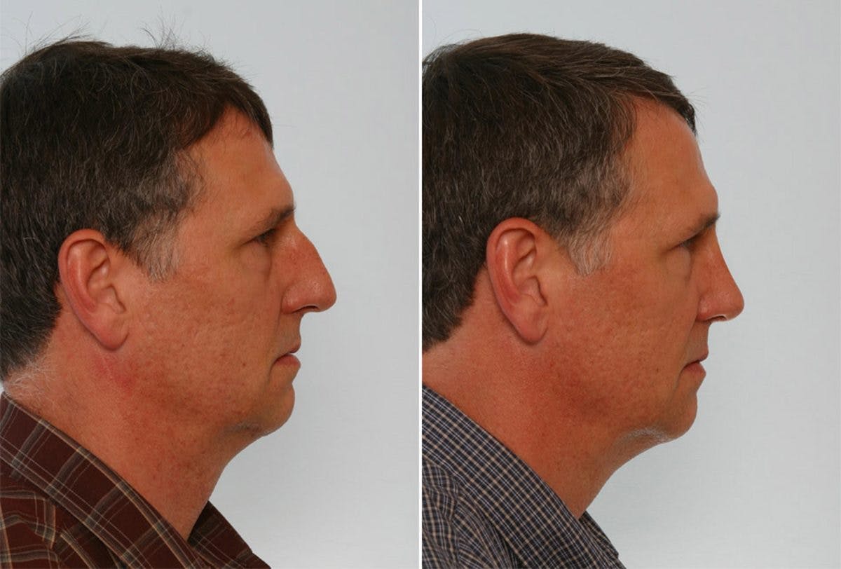 Rhinoplasty Before & After Gallery - Patient 55171280 - Image 2