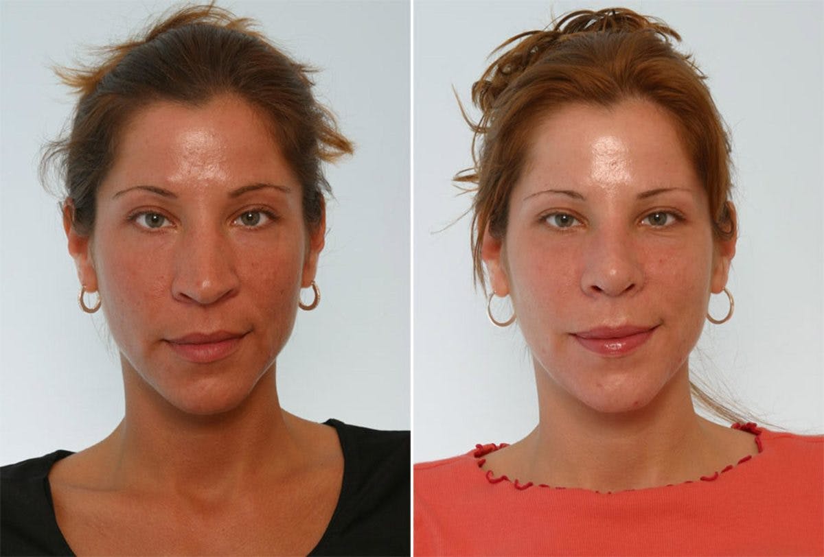 Rhinoplasty Before & After Gallery - Patient 55171281 - Image 1