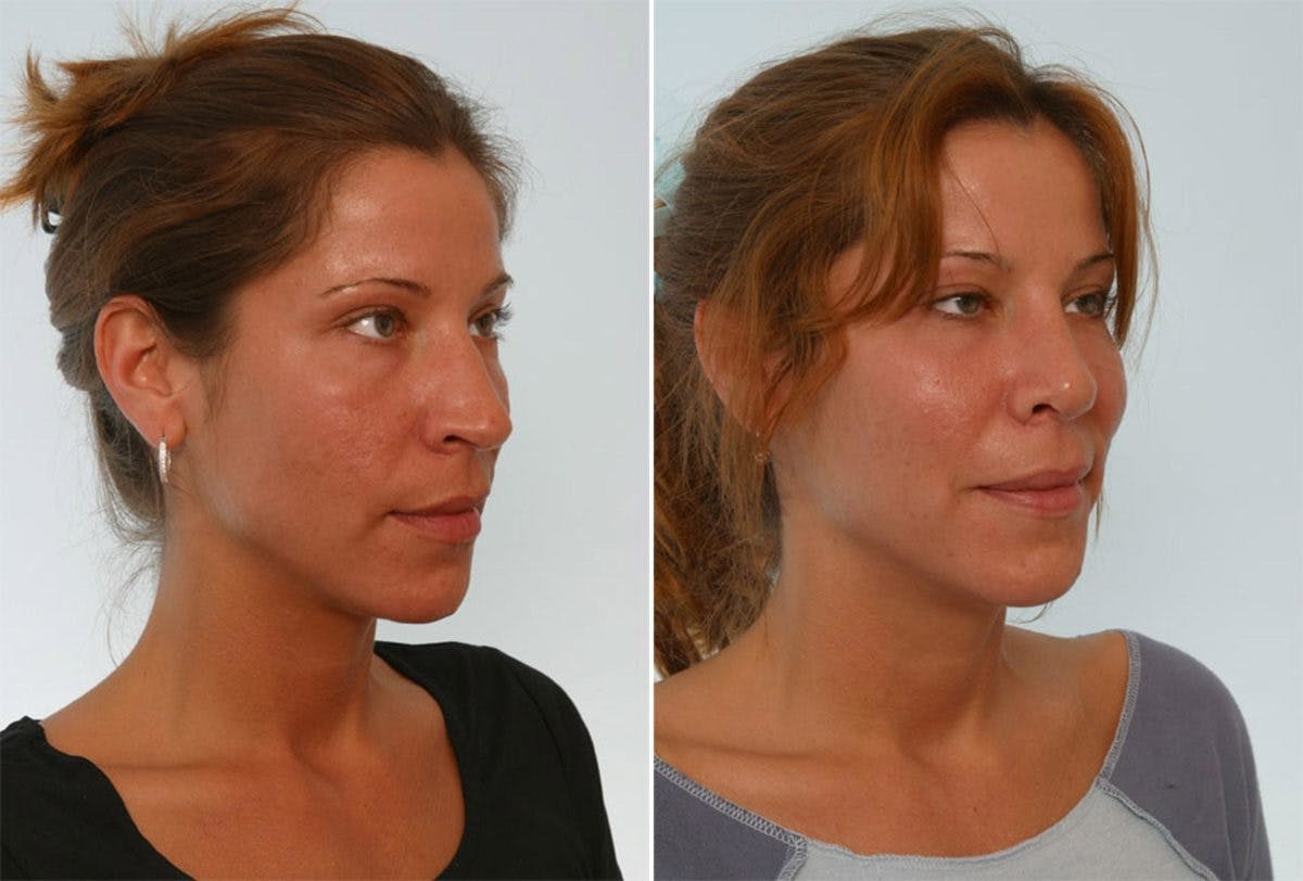 Rhinoplasty Before & After Gallery - Patient 55171281 - Image 3