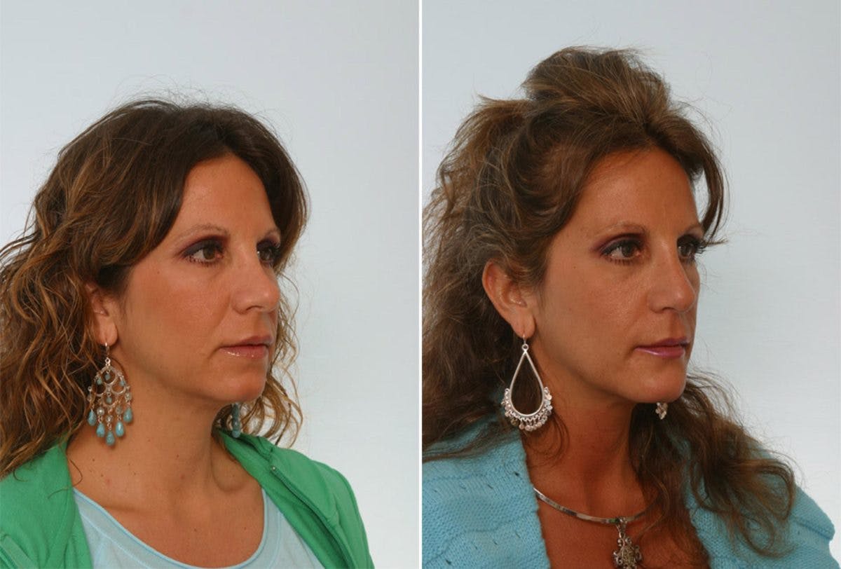 Rhinoplasty Before & After Gallery - Patient 55171282 - Image 3