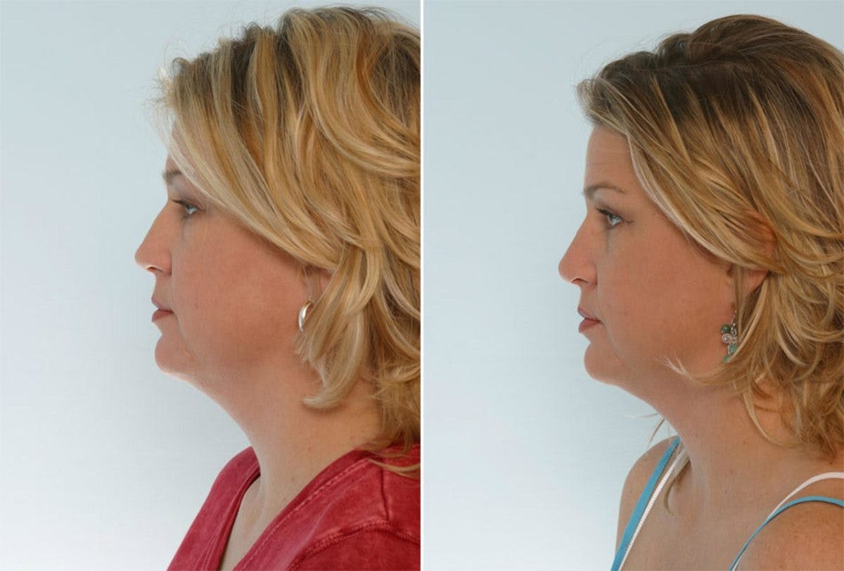 Rhinoplasty Before & After Gallery - Patient 55171283 - Image 2