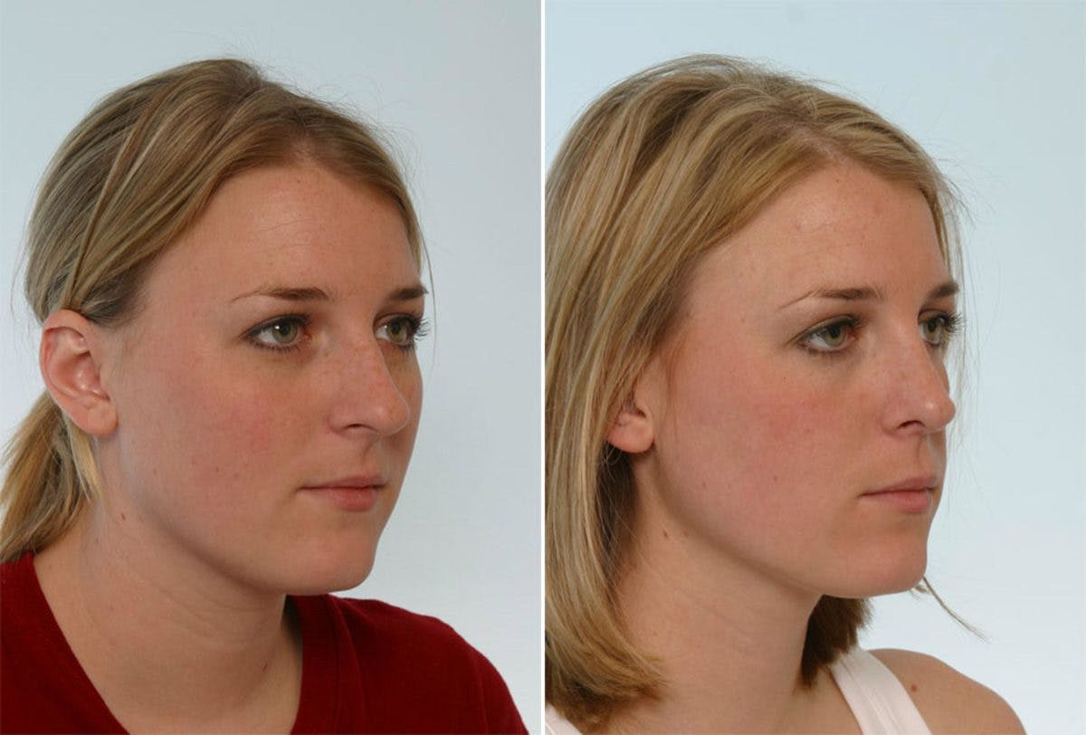Rhinoplasty Before & After Gallery - Patient 55171284 - Image 3