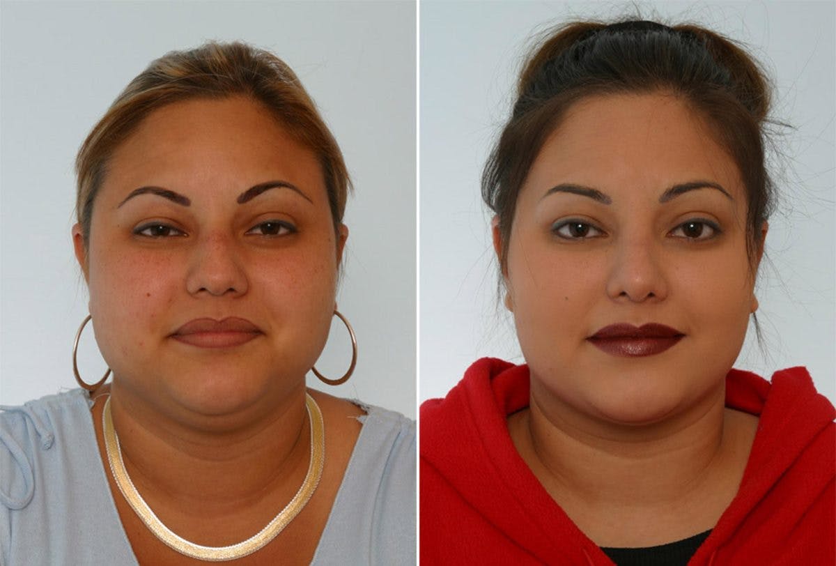 Rhinoplasty Before & After Gallery - Patient 55171285 - Image 1