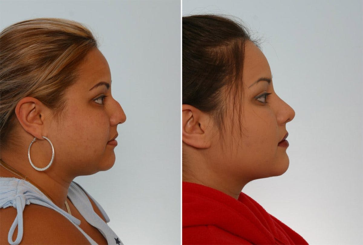 Rhinoplasty Before & After Gallery - Patient 55171285 - Image 2