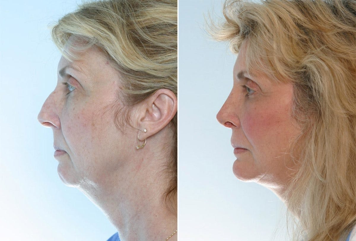 Rhinoplasty Before & After Gallery - Patient 55171286 - Image 2
