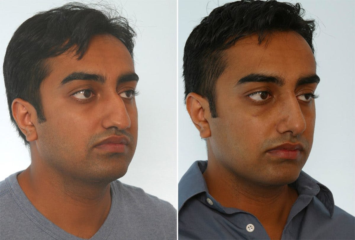 Rhinoplasty Before & After Photo - Patient 55171287 - Image 3