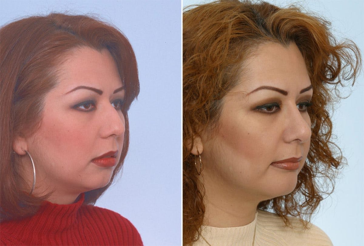 Rhinoplasty Before & After Gallery - Patient 55171288 - Image 3