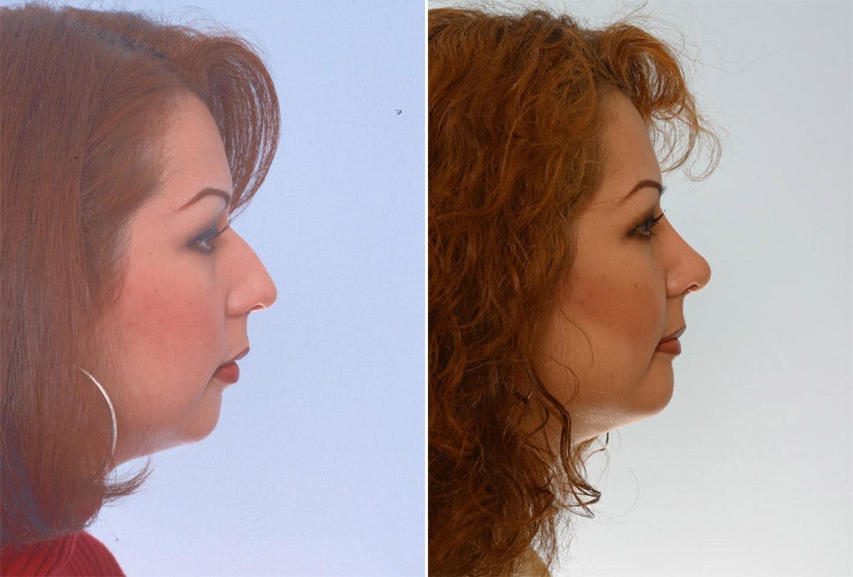 Rhinoplasty Before & After Photo - Patient 55171288 - Image 2