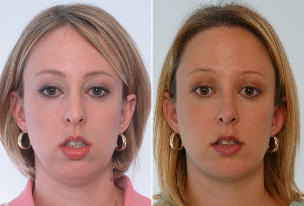 Rhinoplasty Before & After Gallery - Patient 55171289 - Image 1