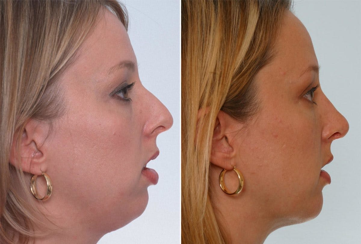 Rhinoplasty Before & After Gallery - Patient 55171289 - Image 2