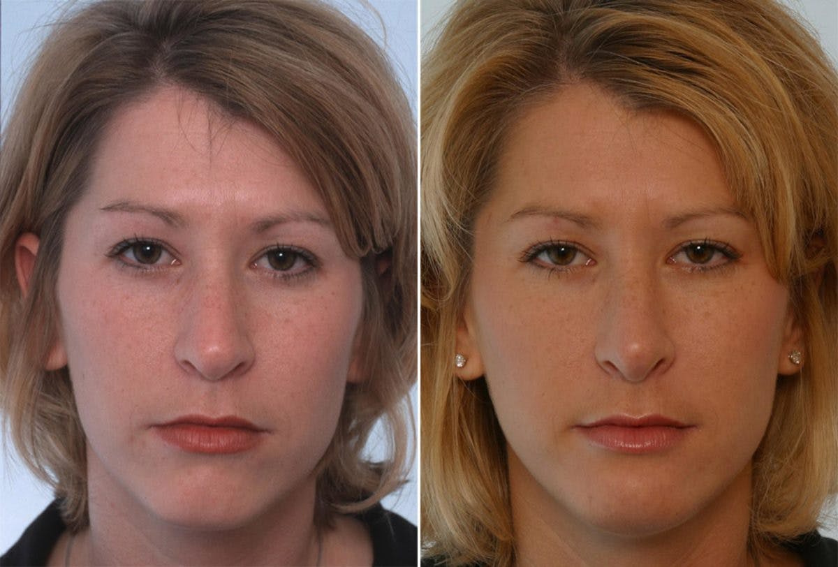 Rhinoplasty Before & After Gallery - Patient 55171290 - Image 1